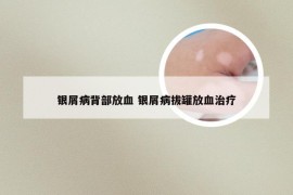 银屑病背部放血 银屑病拔罐放血治疗