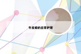 牛皮癣的日常护理