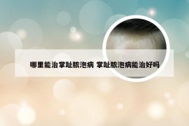 哪里能治掌趾脓泡病 掌趾脓泡病能治好吗