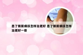 患了银屑病该怎样治更好 患了银屑病该怎样治更好一些