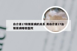 白介素17和银屑病的关系 用白介素17治银屑病哪些医院