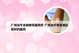 广州治牛皮癣哪家医院好 广州治疗银屑病比较好的医院