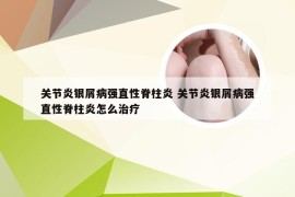 关节炎银屑病强直性脊柱炎 关节炎银屑病强直性脊柱炎怎么治疗