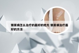 银屑病怎么治疗的最好的地方 银屑病治疗最好的方法