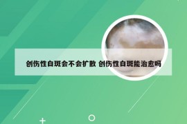 创伤性白斑会不会扩散 创伤性白斑能治愈吗