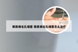 银屑病毛孔堵塞 银屑病毛孔堵塞怎么治疗