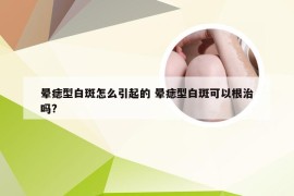 晕痣型白斑怎么引起的 晕痣型白斑可以根治吗?