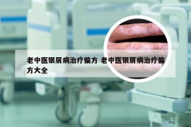 老中医银屑病治疗偏方 老中医银屑病治疗偏方大全