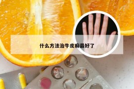 什么方法治牛皮癣最好了