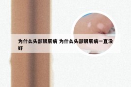 为什么头部银屑病 为什么头部银屑病一直没好