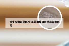 治牛皮癣东莞医院 东莞治疗银屑病最好的医院
