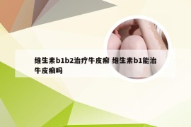 维生素b1b2治疗牛皮癣 维生素b1能治牛皮癣吗