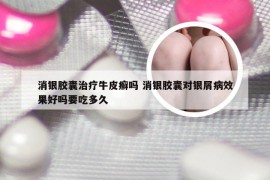 消银胶囊治疗牛皮癣吗 消银胶囊对银屑病效果好吗要吃多久