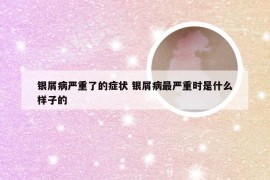 银屑病严重了的症状 银屑病最严重时是什么样子的