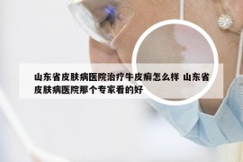 山东省皮肤病医院治疗牛皮癣怎么样 山东省皮肤病医院那个专家看的好
