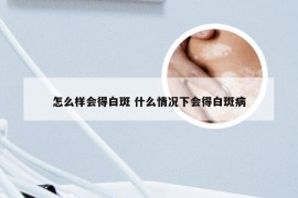 怎么样会得白斑 什么情况下会得白斑病