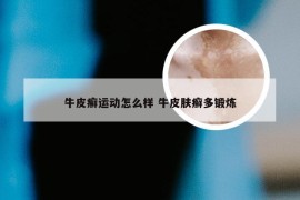 牛皮癣运动怎么样 牛皮肤癣多锻炼