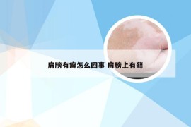 肩膀有癣怎么回事 肩膀上有藓