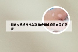 银肖皮肤病用什么药 治疗银皮癣最有效的药膏