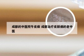 成都的中医院牛皮癣 成都治疗皮肤病的老中医