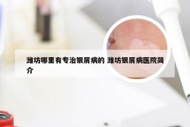 潍坊哪里有专治银屑病的 潍坊银屑病医院简介