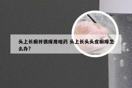 头上长癣并很痒用啥药 头上长头头皮癣痒怎么办?
