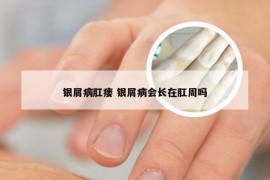 银屑病肛瘘 银屑病会长在肛周吗