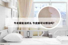 牛皮廨能治好么 牛皮廨可以根治吗?