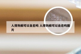 人得狗癣可以自愈吗 人得狗癣可以自愈吗图片