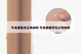 牛皮癣能吃公鸡肉吗 牛皮肤癣可吃公鸡肉吗