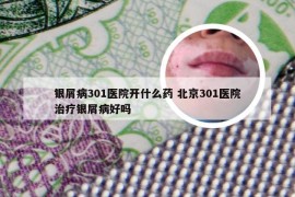 银屑病301医院开什么药 北京301医院治疗银屑病好吗