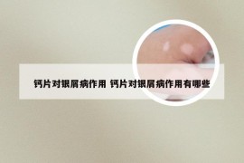 钙片对银屑病作用 钙片对银屑病作用有哪些