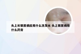 头上长银屑病应用什么洗发水 头上银屑病擦什么药膏