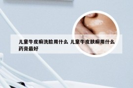 儿童牛皮癣洗脸用什么 儿童牛皮肤癣用什么药膏最好