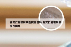 西安仁爱银屑病医院靠谱吗 西安仁爱银屑病医院图片