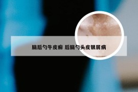 脑后勺牛皮癣 后脑勺头皮银屑病