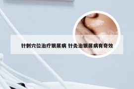 针刺穴位治疗银屑病 针灸治银屑病有奇效