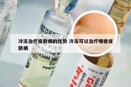 冷冻治疗皮肤病的优势 冷冻可以治疗哪些皮肤病