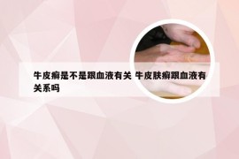 牛皮癣是不是跟血液有关 牛皮肤癣跟血液有关系吗