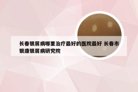 长春银屑病哪里治疗最好的医院最好 长春市银康银屑病研究院