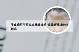 牛皮癣可不可以吃林蛙油吗 银屑病可以吃林蛙吗