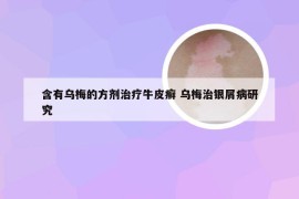 含有乌梅的方剂治疗牛皮癣 乌梅治银屑病研究