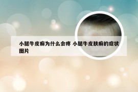 小腿牛皮癣为什么会疼 小腿牛皮肤癣的症状图片