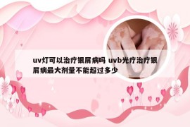 uv灯可以治疗银屑病吗 uvb光疗治疗银屑病最大剂量不能超过多少