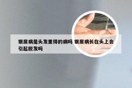 银屑病是头发里得的病吗 银屑病长在头上会引起脱发吗