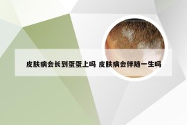皮肤病会长到蛋蛋上吗 皮肤病会伴随一生吗