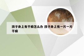 孩子身上有干癣怎么办 孩子身上有一片一片干癣