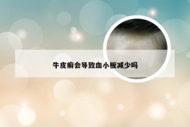 牛皮癣会导致血小板减少吗