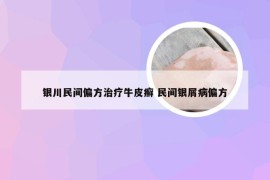 银川民间偏方治疗牛皮癣 民间银屑病偏方