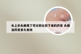 头上长头癣用了可以软化扣下来的药膏 头癣涂药膏多久有效